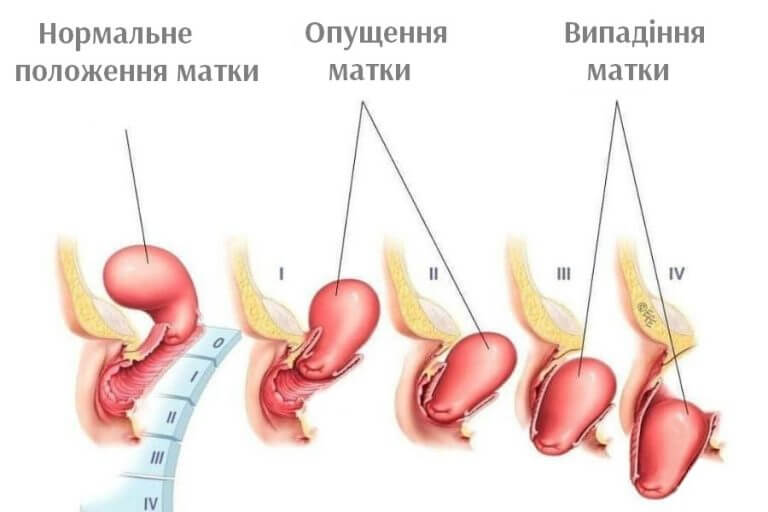 випадение матки