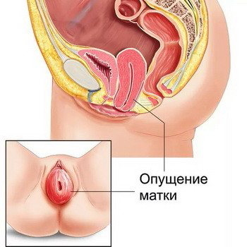 проплас матки