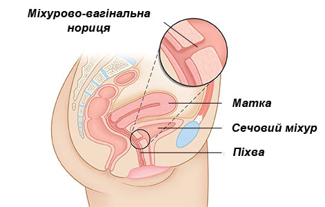 Мочеточно-влагалищный свищ
